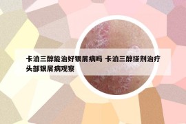 卡泊三醇能治好銀屑病嗎 卡泊三醇搽劑治療頭部銀屑病觀察