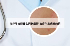 治療牛皮蘚什么藥物最好 治療牛皮病癬的藥