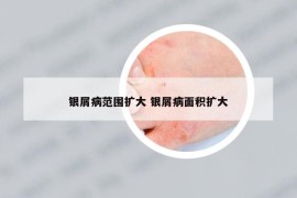 銀屑病范圍擴(kuò)大 銀屑病面積擴(kuò)大