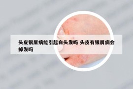 頭皮銀屑病能引起白頭發(fā)嗎 頭皮有銀屑病會掉發(fā)嗎