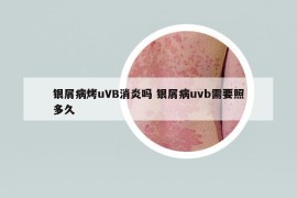 銀屑病烤uVB消炎嗎 銀屑病uvb需要照多久
