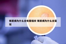 銀屑病為什么會有萎縮紋 銀屑病為什么會蔓延