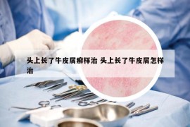 頭上長了牛皮屑癬樣治 頭上長了牛皮屑怎樣治
