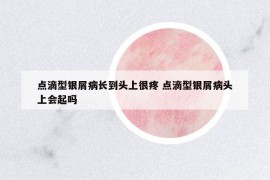 點滴型銀屑病長到頭上很疼 點滴型銀屑病頭上會起嗎