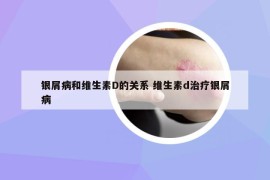 銀屑病和維生素D的關(guān)系 維生素d治療銀屑病