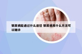 銀屑病能通過什么途徑 銀屑病用什么方法可以確診