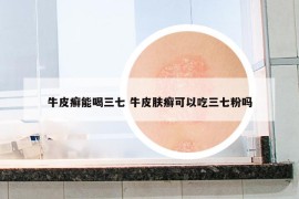 牛皮癬能喝三七 牛皮膚癬可以吃三七粉嗎