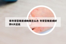 得尋常型銀屑病晚期怎么辦 尋常型銀屑病好轉(zhuǎn)6大征兆