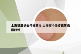 上海銀屑病去何處醫(yī)治 上海哪個治療銀屑病醫(yī)院好