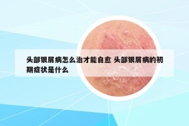 頭部銀屑病怎么治才能自愈 頭部銀屑病的初期癥狀是什么