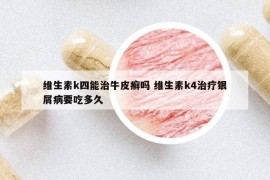 維生素k四能治牛皮癬嗎 維生素k4治療銀屑病要吃多久