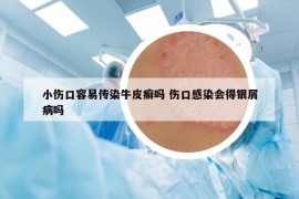 小傷口容易傳染牛皮癬嗎 傷口感染會得銀屑病嗎