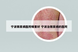寧波銀屑病醫(yī)院哪里好 寧波治銀屑病的醫(yī)院