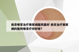 南京哪家治療銀屑病醫(yī)院最好 南京治療銀屑病的醫(yī)院哪家療效好些?