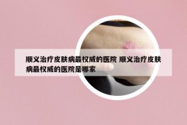 順義治療皮膚病最權(quán)威的醫(yī)院 順義治療皮膚病最權(quán)威的醫(yī)院是哪家