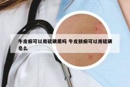 牛皮癬可以用硫磺熏嗎 牛皮膚癬可以用硫磺皂么