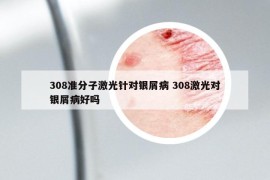 308準(zhǔn)分子激光針對銀屑病 308激光對銀屑病好嗎