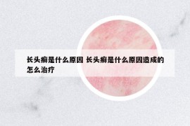 長頭癬是什么原因 長頭癬是什么原因造成的怎么治療