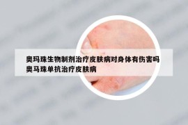 奧瑪珠生物制劑治療皮膚病對(duì)身體有傷害嗎 奧馬珠單抗治療皮膚病