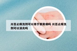 川百止癢洗劑可以用于銀屑病嗎 川百止癢洗劑可以消炎嗎