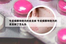 牛皮癬那塊地方的皮去掉 牛皮癬那塊地方的皮去掉了怎么辦