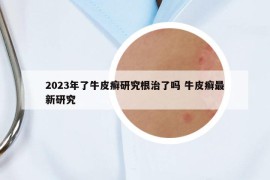 2023年了牛皮癬研究根治了嗎 牛皮癬最新研究
