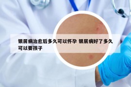 銀屑病治愈后多久可以懷孕 銀屑病好了多久可以要孩子