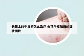 頭頂上的牛皮癬怎么治療 頭頂牛皮膚癬的癥狀圖片