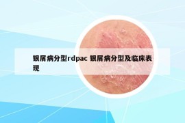 銀屑病分型rdpac 銀屑病分型及臨床表現(xiàn)