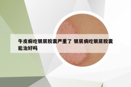 牛皮癬吃銀屑膠囊嚴(yán)重了 銀屑病吃銀屑膠囊能治好嗎