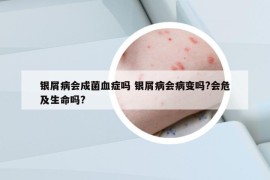 銀屑病會成菌血癥嗎 銀屑病會病變嗎?會危及生命嗎?