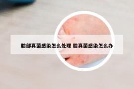 臉部真菌感染怎么處理 臉真菌感染怎么辦