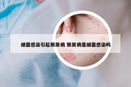 細(xì)菌感染引起銀屑病 銀屑病是細(xì)菌感染嗎
