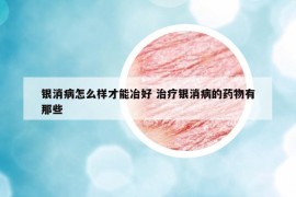 銀消病怎么樣才能冶好 治療銀消病的藥物有那些