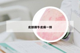 皮膚跟牛皮癬一樣