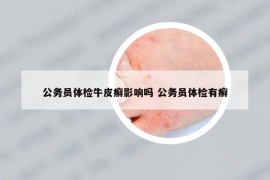 公務(wù)員體檢牛皮癬影響嗎 公務(wù)員體檢有癬