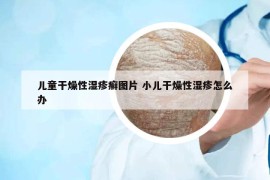 兒童干燥性濕疹癬圖片 小兒干燥性濕疹怎么辦