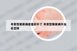 尋常性銀屑病老是好不了 尋常型銀屑病不治會(huì)怎樣