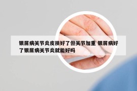 銀屑病關(guān)節(jié)炎皮損好了但關(guān)節(jié)加重 銀屑病好了銀屑病關(guān)節(jié)炎就能好嗎
