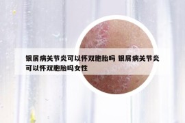 銀屑病關(guān)節(jié)炎可以懷雙胞胎嗎 銀屑病關(guān)節(jié)炎可以懷雙胞胎嗎女性