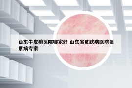 山東牛皮癬醫(yī)院哪家好 山東省皮膚病醫(yī)院銀屑病專家