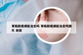 掌跖膿皰病能治愈嗎 掌跖膿皰病能治愈嗎圖片 絕癥