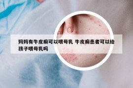 媽媽有牛皮癬可以喂母乳 牛皮癬患者可以給孩子喂母乳嗎
