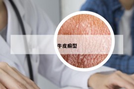 牛皮癬型
