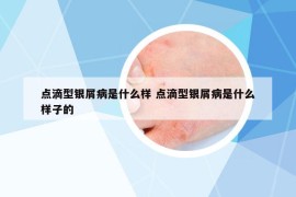 點(diǎn)滴型銀屑病是什么樣 點(diǎn)滴型銀屑病是什么樣子的