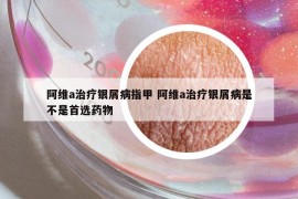 阿維a治療銀屑病指甲 阿維a治療銀屑病是不是首選藥物