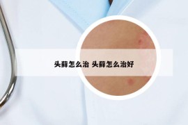 頭蘚怎么治 頭蘚怎么治好