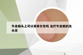 牛皮癬頭上可以用希爾生嗎 治療牛皮癬的洗頭膏