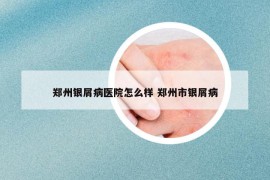 鄭州銀屑病醫(yī)院怎么樣 鄭州市銀屑病