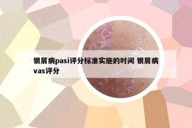 銀屑病pasi評(píng)分標(biāo)準(zhǔn)實(shí)施的時(shí)間 銀屑病vas評(píng)分